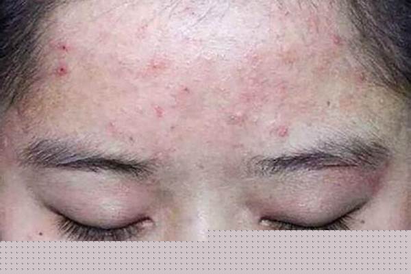 吃辣第二天长痘痘